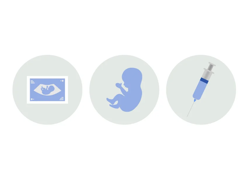 89procs_amniocentesis2.webp